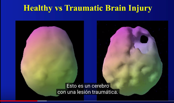 Diferencia entre un cerebro sano  y uno enfermo